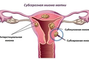 Субсерозная миома матки: причины возникновения и основные симптомы, способы лечения заболевания