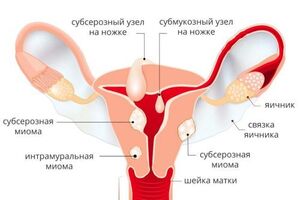 Субмукозная миома матки: причины возникновения и основные симптомы, способы лечения заболевания