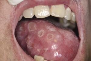 Сифилис полости рта: причины возникновения и основные симптомы, способы лечения заболевания