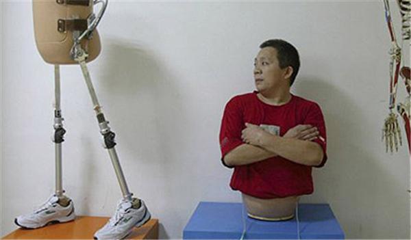 Китаєць, розрізаний навпіл 13 років тому, вчиться ходити