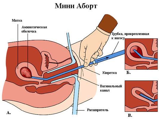 Світ відмовився від абортів