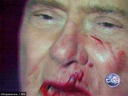 Берлусконі належить лікуватися не один тиждень (ФОТО)