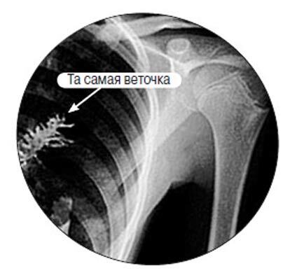 28-річний чоловік виростив ялинку у власних легких! ФОТО