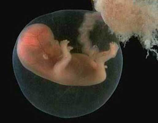В животе у девочки найден эмбрион-паразит