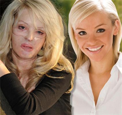 Изуродованная девушка снова будет работать моделью. ФОТО