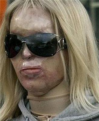 Изуродованная девушка снова будет работать моделью. ФОТО