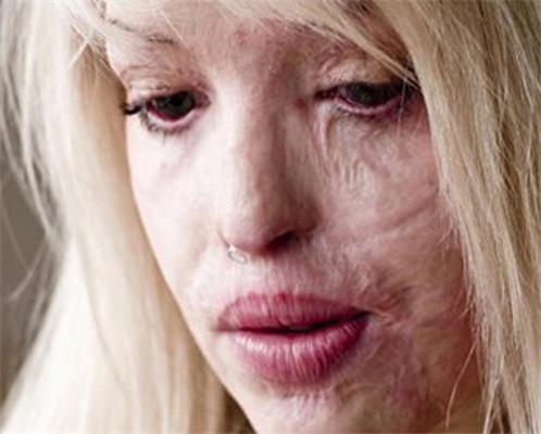 Изуродованная девушка снова будет работать моделью. ФОТО