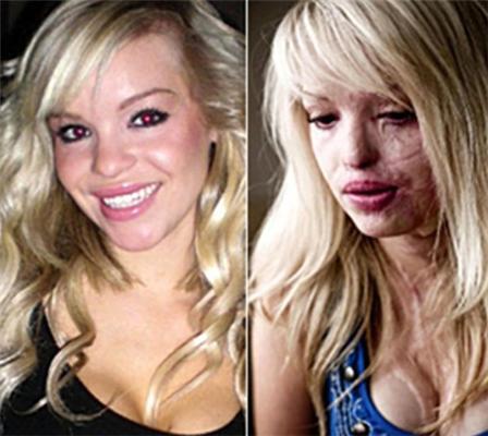 Изуродованная девушка снова будет работать моделью. ФОТО