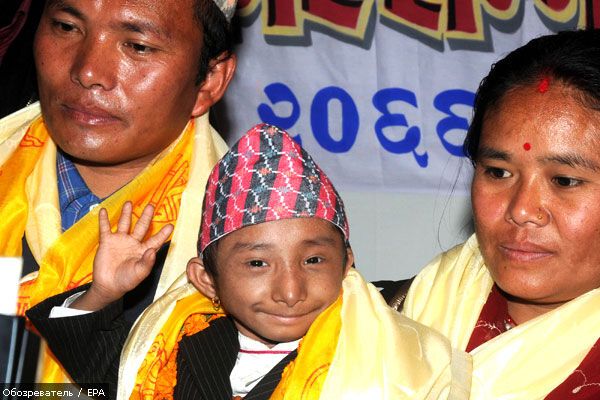 Непалец может стать самым маленьким человеком в мире (ФОТО)