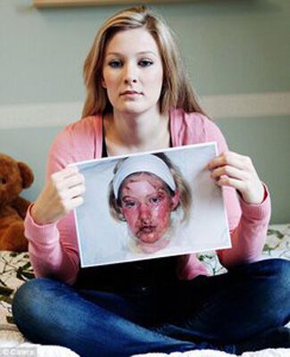 Таблетка парацетамолу спотворила обличчя дівчини