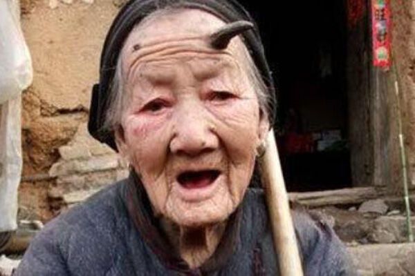 На лобі 101-річної жінки виріс ріг. ФОТО