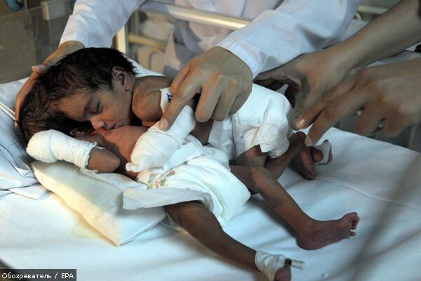 Лікарі рятують зрощених головами сіамських близнюків. ФОТО