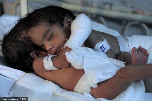 Лікарі рятують зрощених головами сіамських близнюків. ФОТО