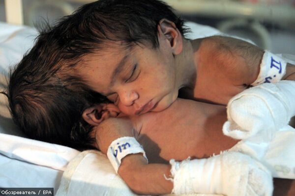 Лікарі рятують зрощених головами сіамських близнюків. ФОТО