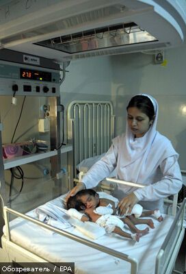 Лікарі рятують зрощених головами сіамських близнюків. ФОТО