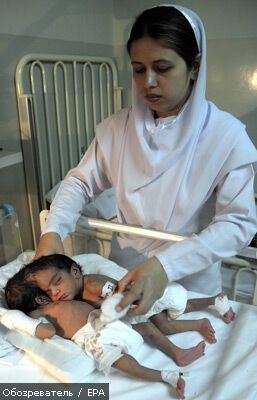 Лікарі рятують зрощених головами сіамських близнюків. ФОТО