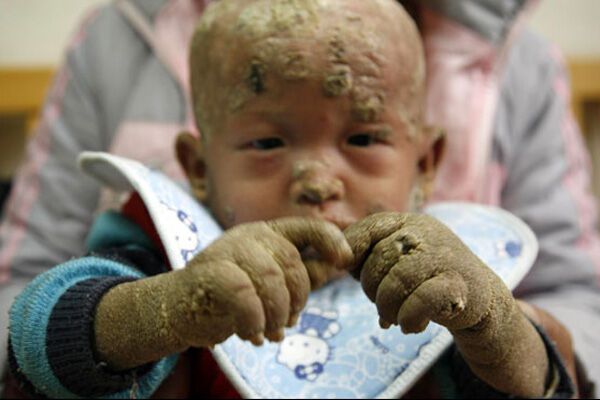 " Хлопчик-риба" рятується у ванні з льодом