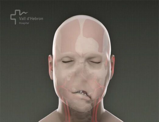 Вперше у світі проведена повна пересадка обличчя. ФОТО і ВІДЕО