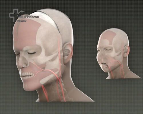 Вперше у світі проведена повна пересадка обличчя. ФОТО і ВІДЕО