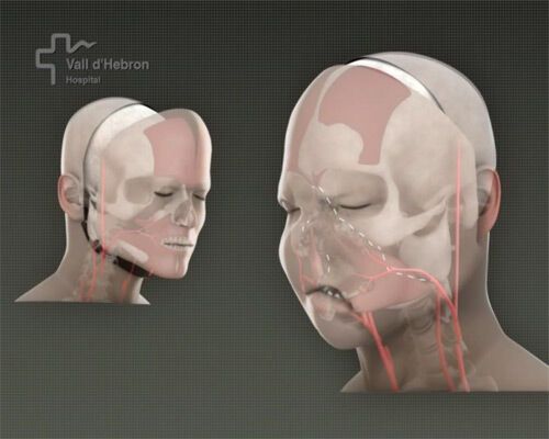 Вперше у світі проведена повна пересадка обличчя. ФОТО і ВІДЕО