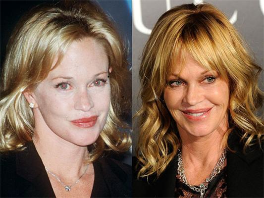 Невдалі пластичні операції знаменитостей 