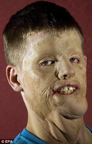 Солдат, пожертвовавший собой ради женщины, получил новое лицо