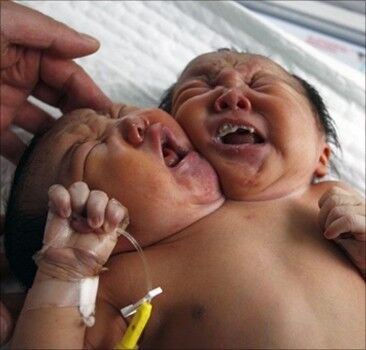 В Китае родилась девочка с двумя головами. Фото