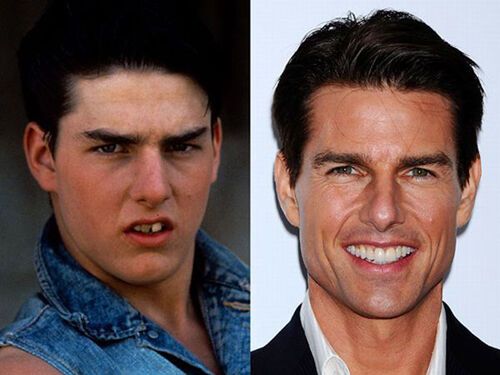 Голливудские звезды до и после стоматолога.Фото