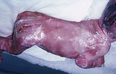 В Англии родился ребенок без кожи. Фото