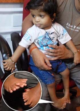 Однорічне немовля побив світовий рекорд по числу пальців. ФОТО