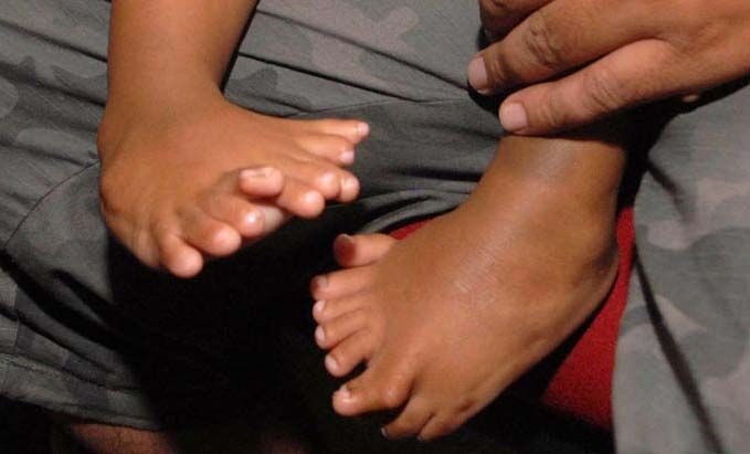 Годовалый младенец побил мировой рекорд по числу пальцев. ФОТО