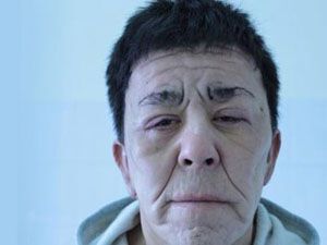 Лікарі омолодили пацієнта, чий організм аномально швидко старіє