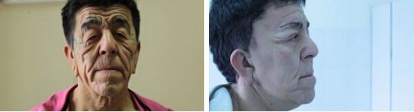 Лікарі омолодили пацієнта, чий організм аномально швидко старіє