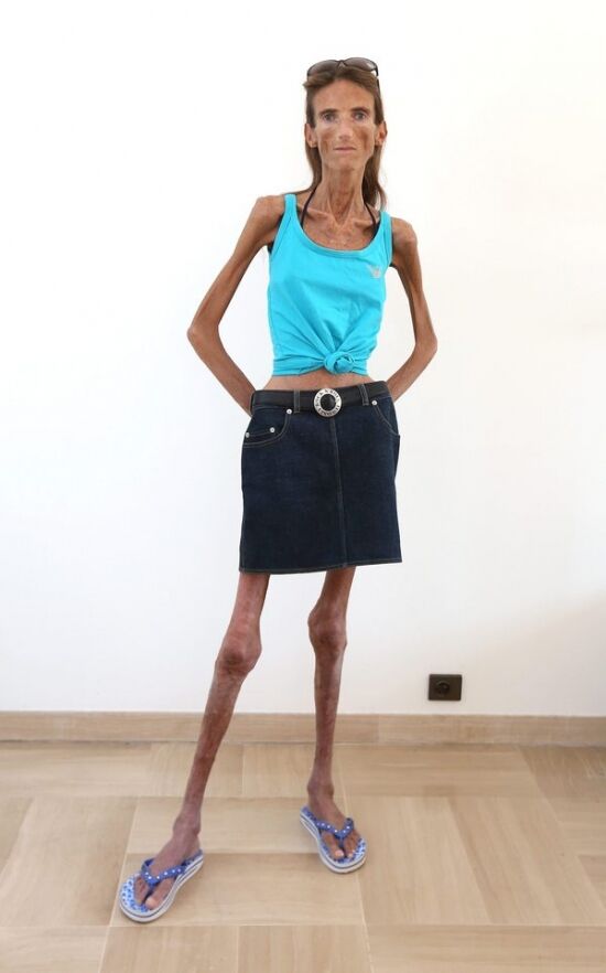 Самая худая женщина в мире весит 25 кг. Фото