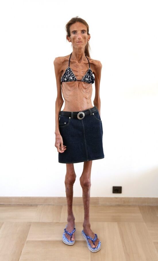 Самая худая женщина в мире весит 25 кг. Фото