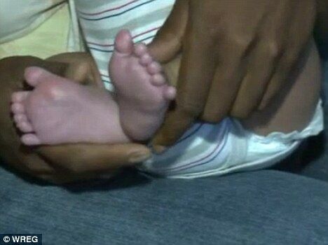 В США родился ребенок с 12 пальцами на ногах