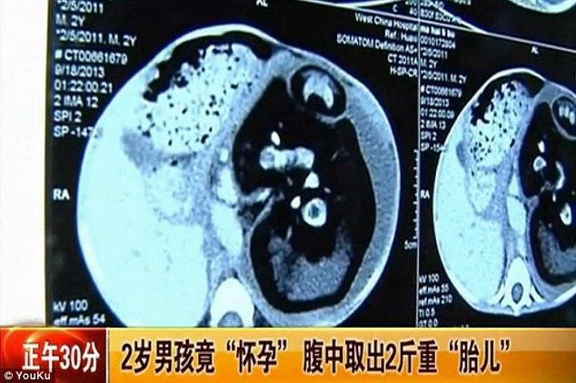 2-летний мальчик в Китае родил своего брата-близнеца