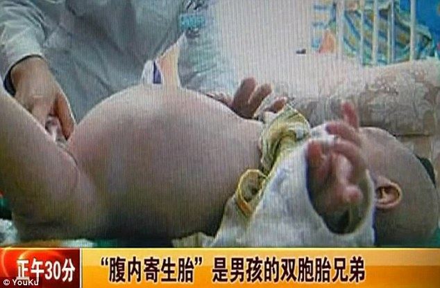 2-річний хлопчик у Китаї породив свого брата-близнюка