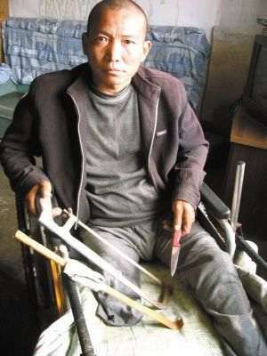 Китаєць ампутував собі ногу, бо не міг оплатити лікування