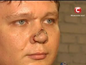 В Киеве "помощник нардепа" откусил нос известному переводчику
