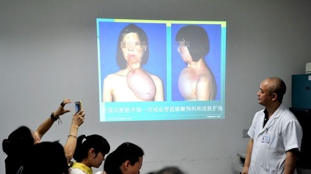 У Китаї медики виростили на грудях 17-річної дівчини особа