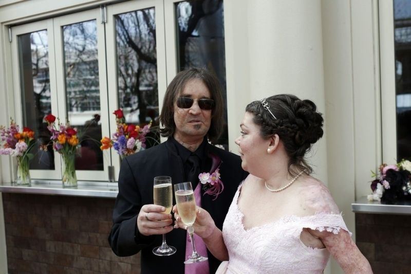 Человек с пересаженным лицом женился на жертве ДТП