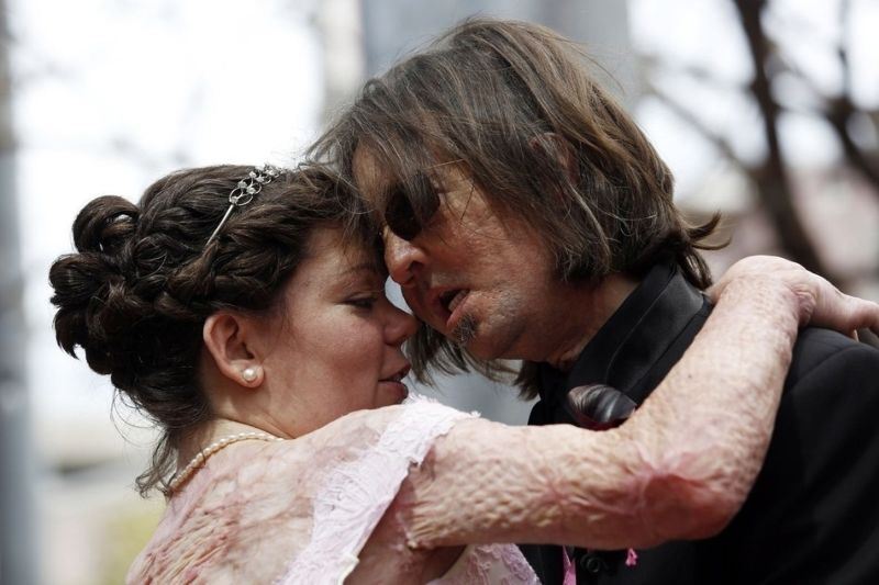 Человек с пересаженным лицом женился на жертве ДТП