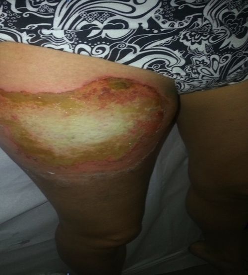 Смартфон сильно обжег девушке ногу