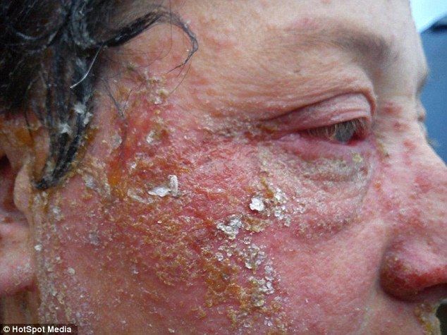 Страшная аллергия на краску для волос изуродовала женщину до неузнаваемости