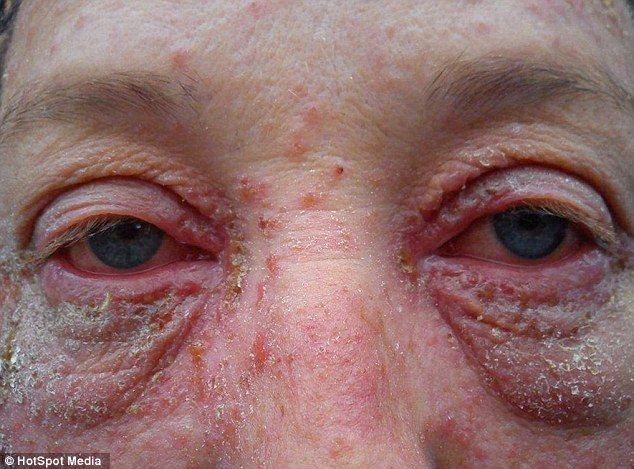 Страшная аллергия на краску для волос изуродовала женщину до неузнаваемости