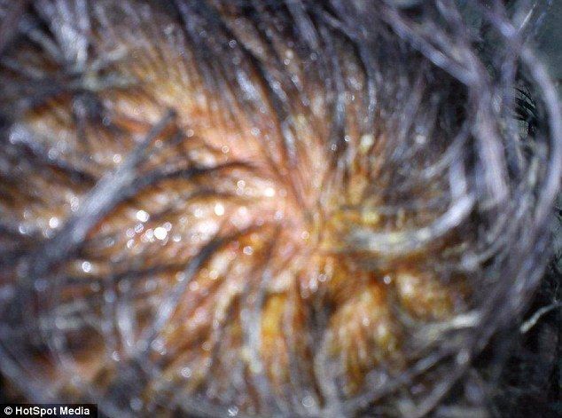 Страшная аллергия на краску для волос изуродовала женщину до неузнаваемости