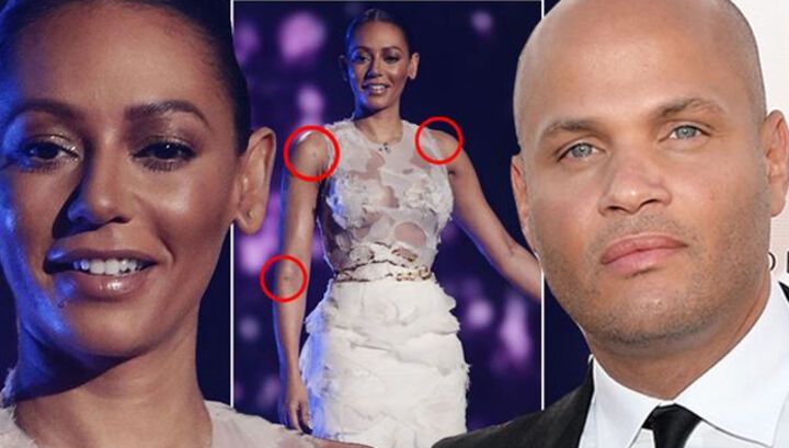 Экс-участница Spice Girls шокировала зрителей телешоу синяками по всему телу