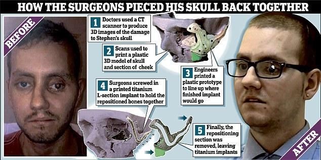 Хирурги напечатали череп британца на 3d принтере