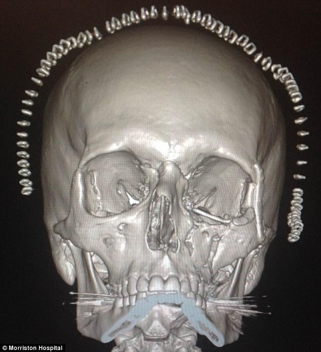 Хирурги напечатали череп британца на 3d принтере